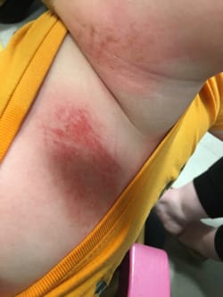 Detergent burn child